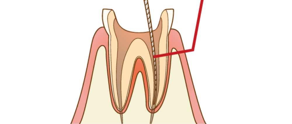 歯を残す治療