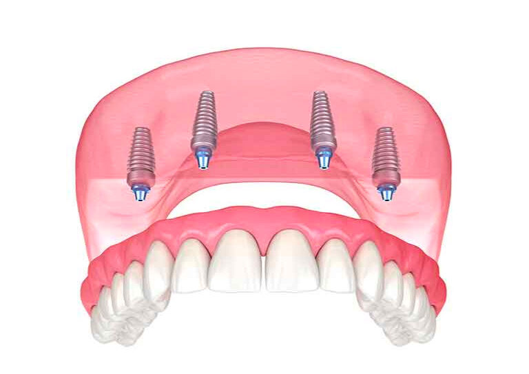 しっかり固定できるインプラント床義歯