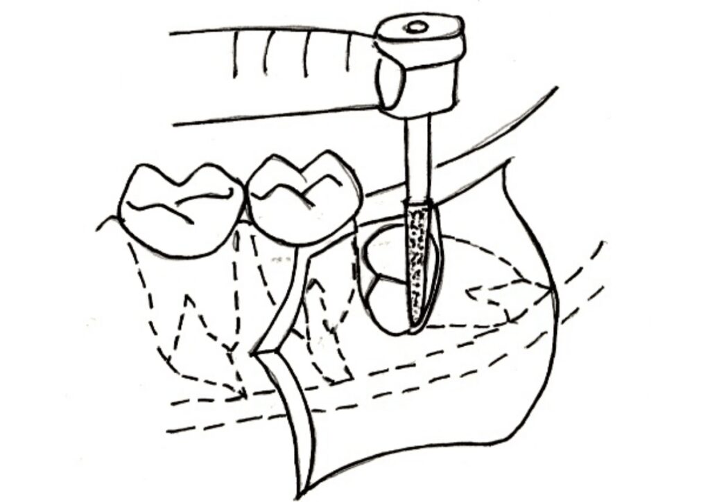 歯冠と歯根の切断