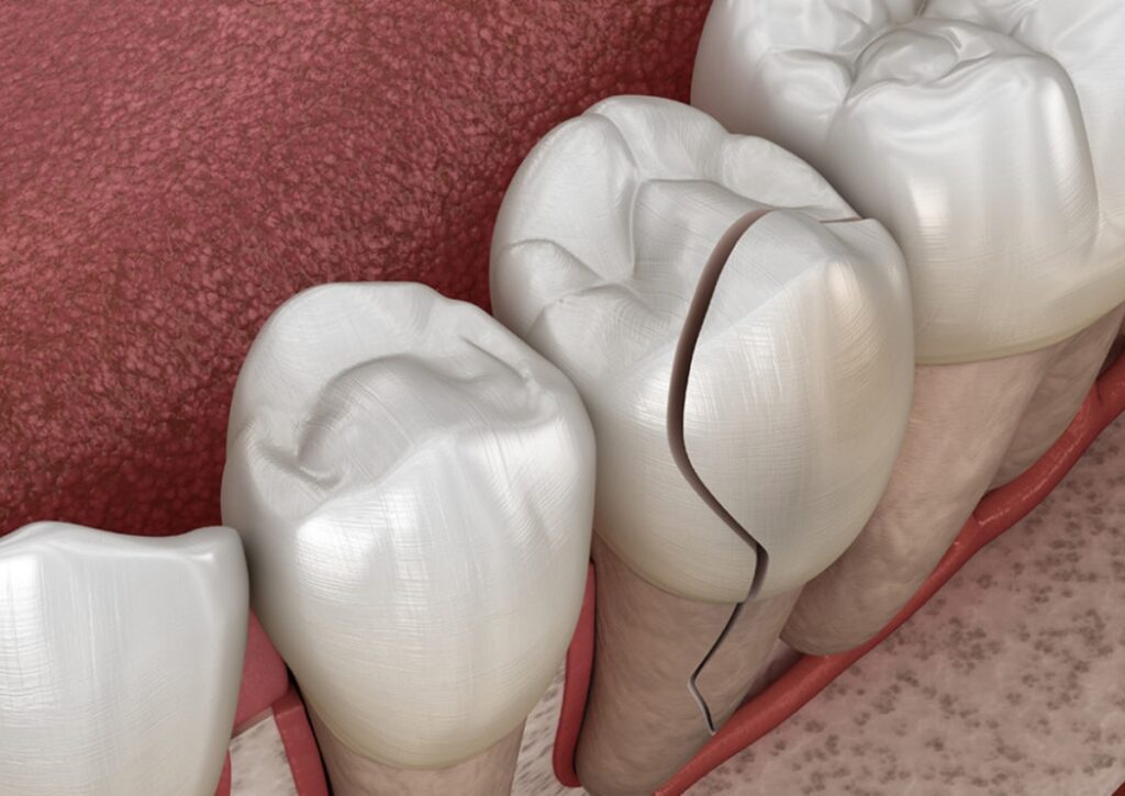 歯の表面の亀裂