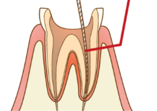 歯を残す治療根管治療（歯の根っこの治療）