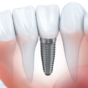 インプラント